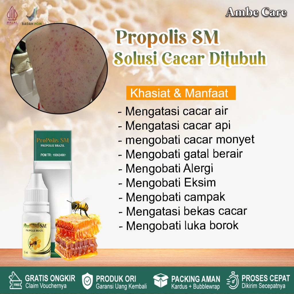 Obat cacar solusi obat cacar air, cacar api, obat cacar monyet,obat infeksi obat campak,propolis sm 