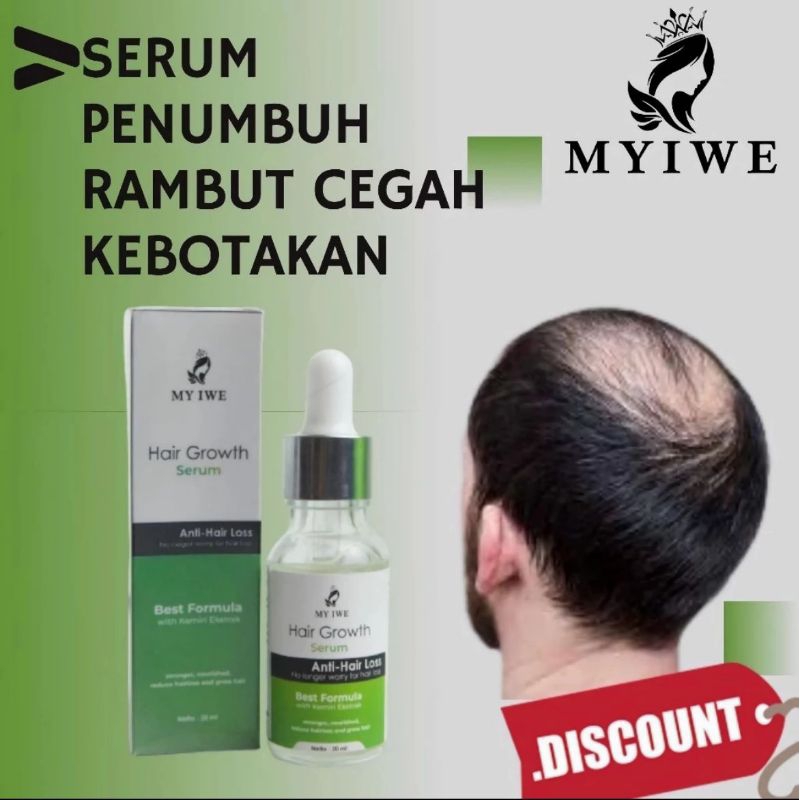 My iwe - penumbuh rambut - penumbuh rambut botak - penumbuh rambut cepat - penumbuh rambut botak pal