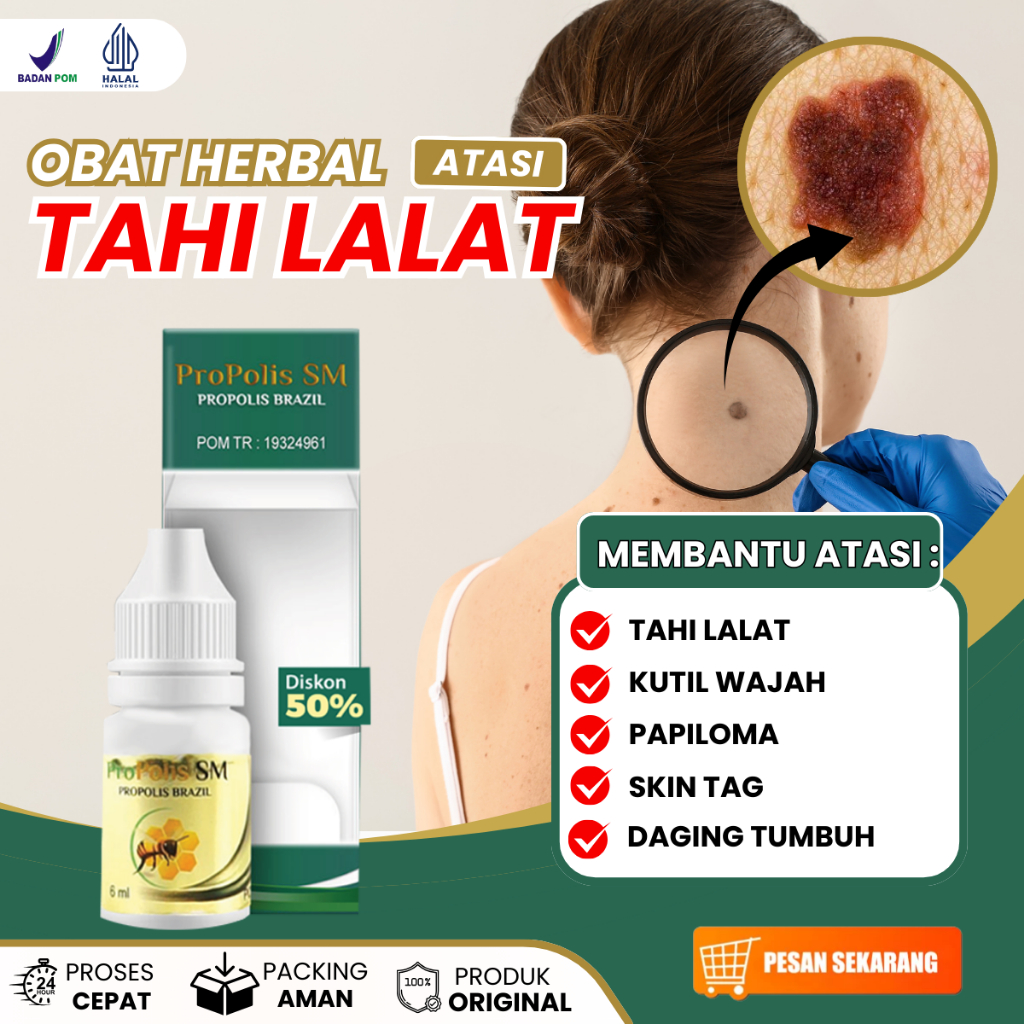 Obat Tetes Perontok Tahi Lalat, Obat Oles Penghilang Tahi Lalat di Wajah, Kutil di Wajah, Skin Tag D