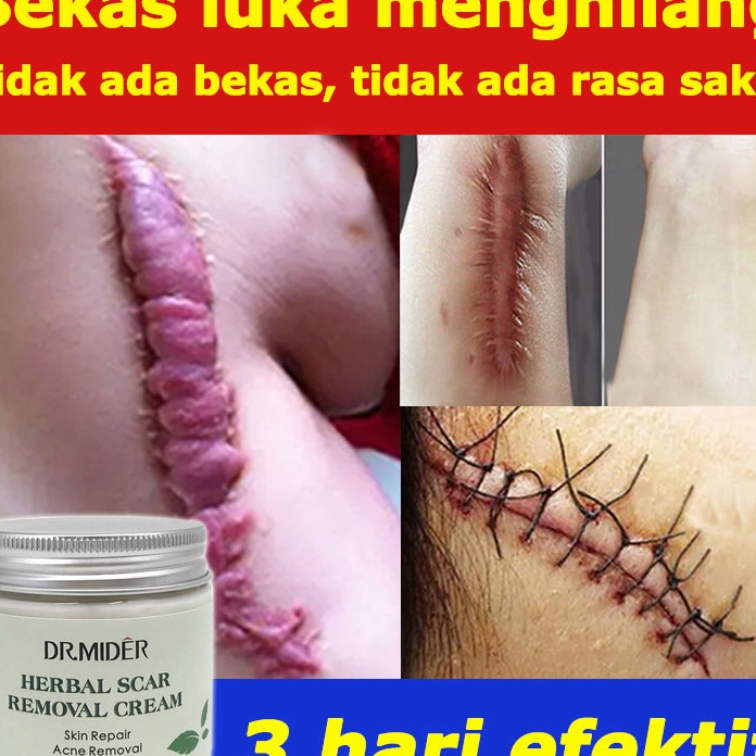 GROSIR 3 hari efektif Penghilang bekas luka Bekas luka menghilang BAKAR SALEP GATAL Salep penghilang