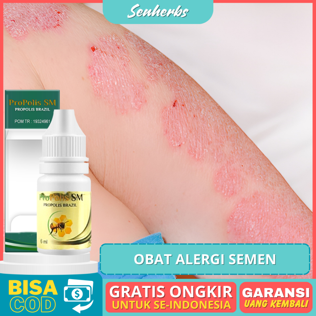 Obat Alergi Semen, Obat Gatal Kulit Alergi Semen, Obat Oles Gatal Alergi Semen Propolis SM