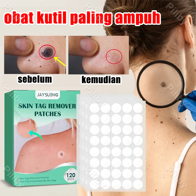 Penghilang Kutil Di Wajah Penghilang Kutil Dan Tahi Lalat Penghilang tahi lalat di wajah Skin tag re