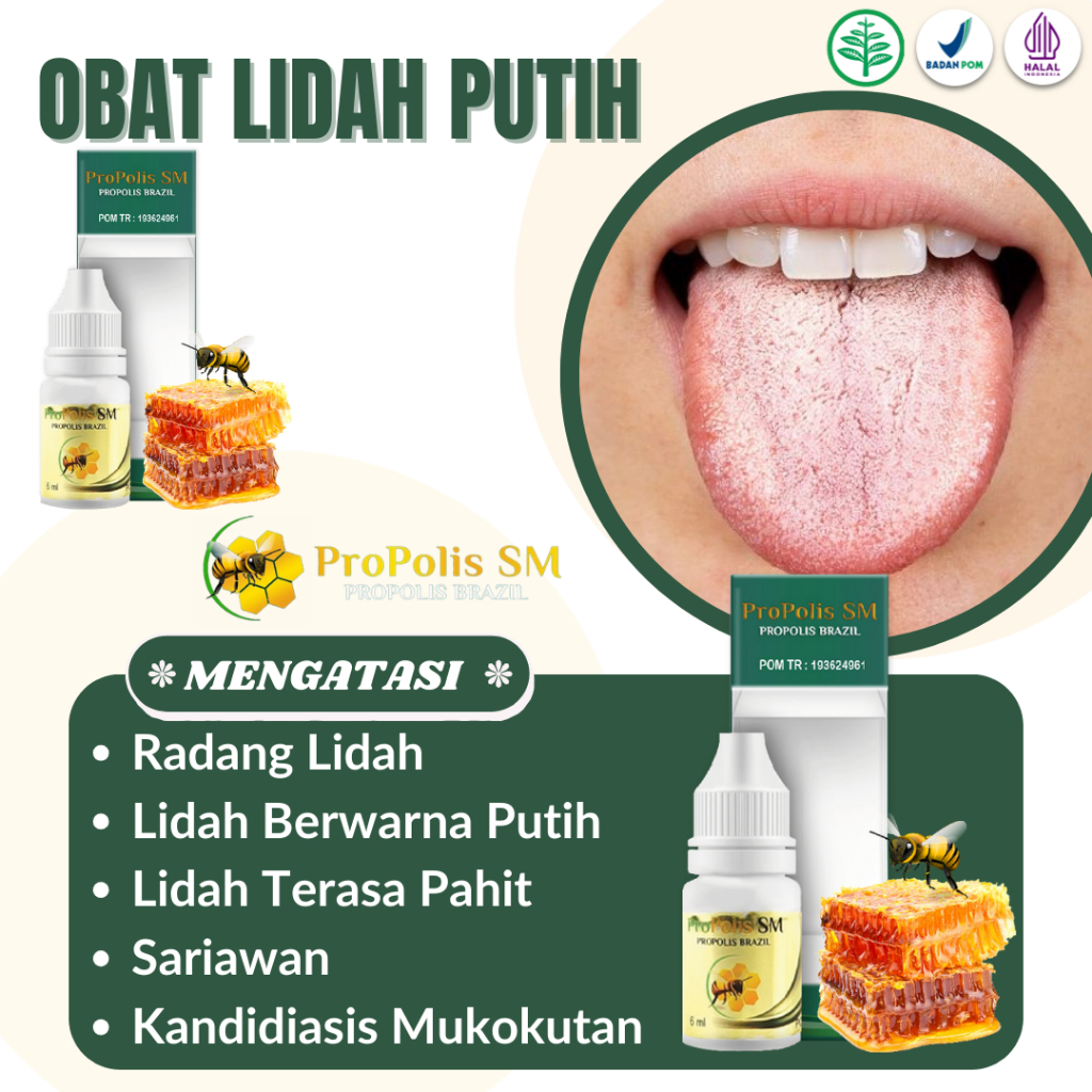 Obat Lidah Putih,Obat Lidah Luka,Obat Lidah Berjamur,Obat Lidah Pecah Pecah- Propolis SM