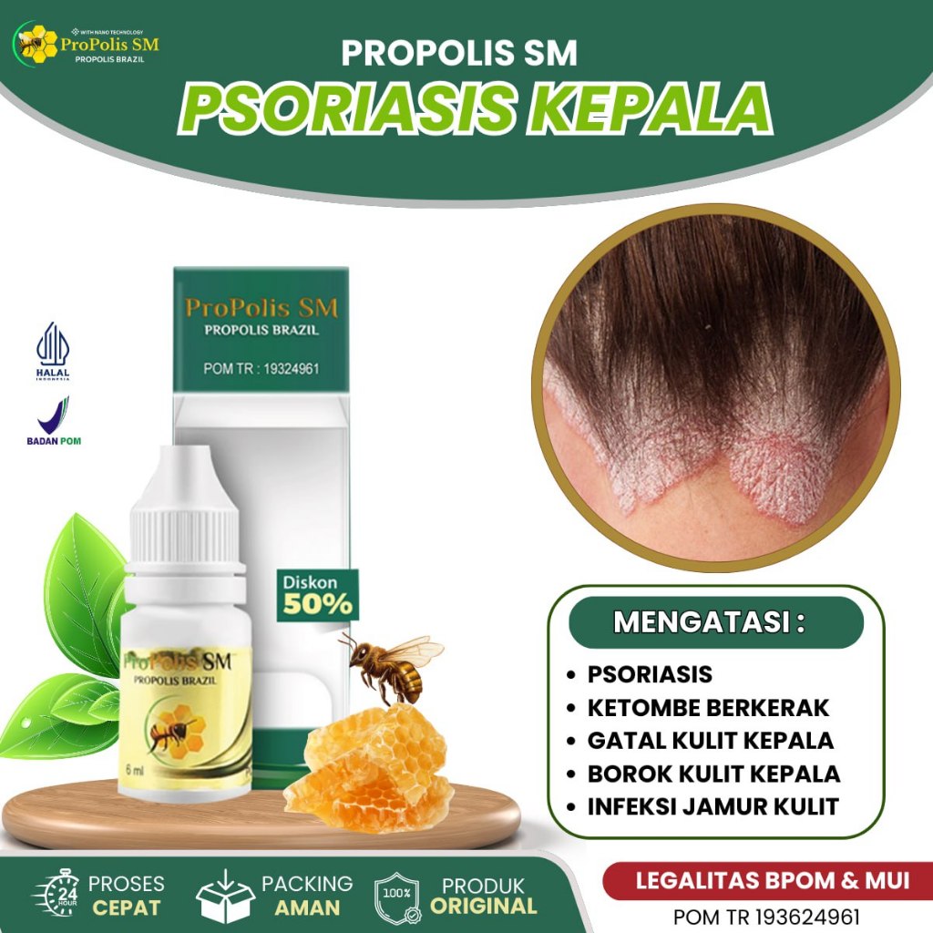 Obat Psoriasias Gatal Jamur Kulit Kepala, Obat Ketombe Basah Kering Kerak Tebal Gatal,Kulit Bersisik