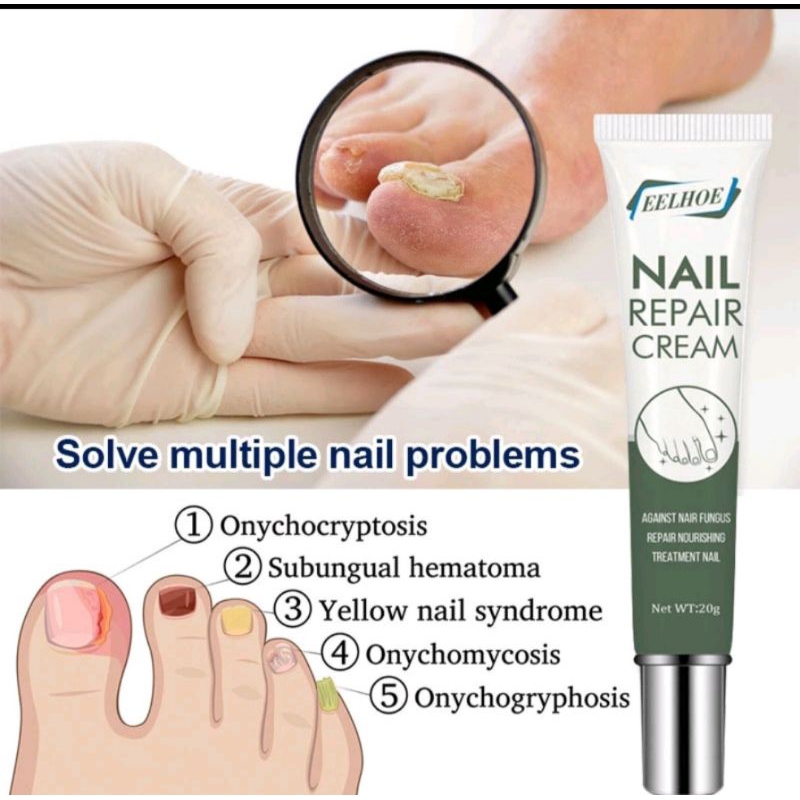 Ellhoe Salep Jamur Kuku. Obat Jamur Kuku Rusak. Perbaikan Kuku Rusak