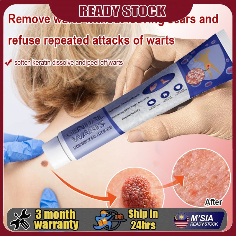 Ubat buang kutil ketuat tahi lalat biji kolestrol Removal Wart Cream Wart Removal Ointment Warts Ski