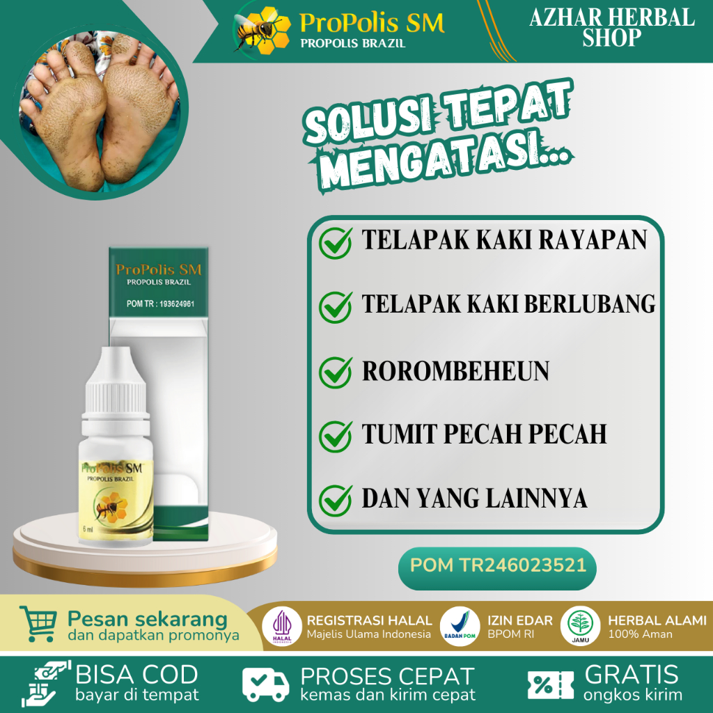 Propolis SM Obat Kaki Rayapan, Telapak kaki Bolong Bolong, Obat Telapak Kaki Rayapan, Rorombeheun