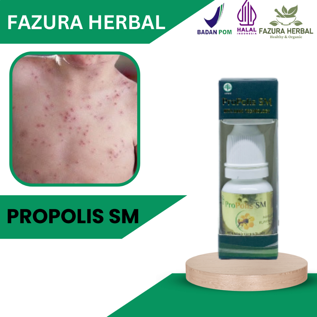 Propolis SM - Obat Gatal Seluruh Badan, Obat Gatal Kulit, Obat Gatal Miss V Kewanitaan, Obat Gatal G