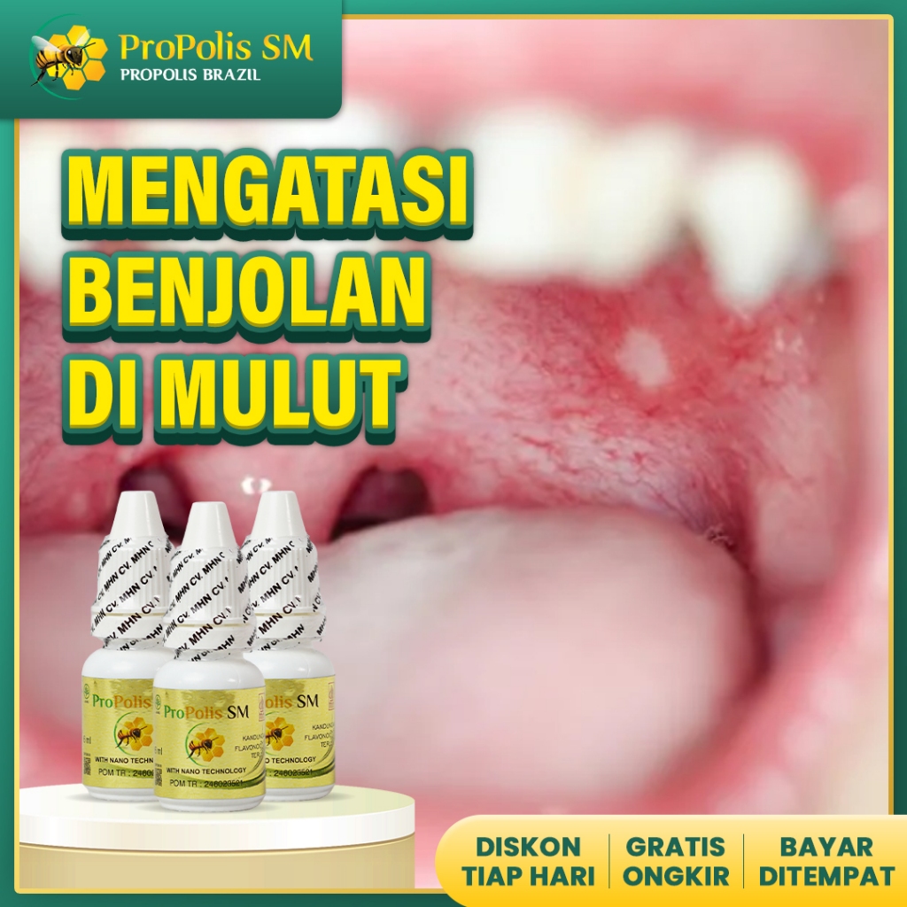 Obat benjolan mulObat Mukokel, Penghilang benjolan di bawah lidah,Obat Benjolan Di Bibir Mulut Lidah