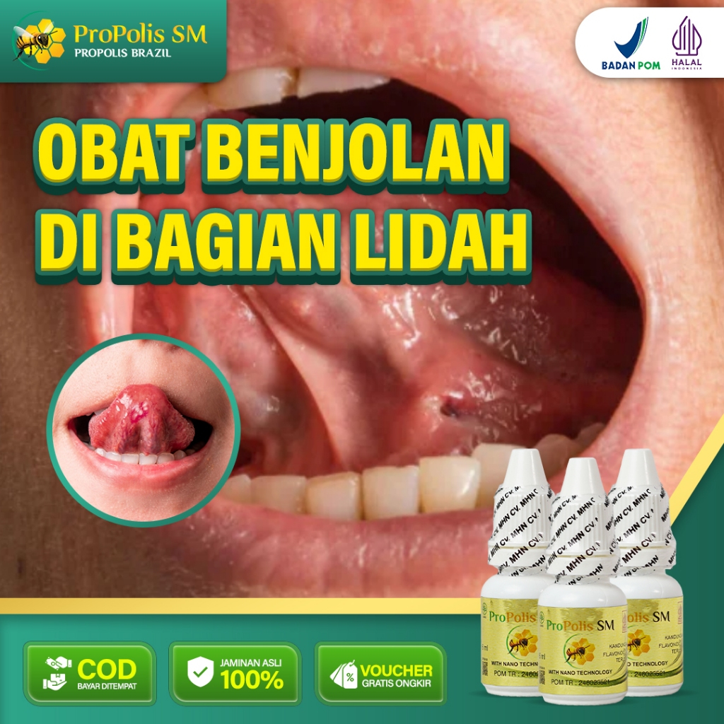 obat benjolan di lidah,benjolan bawah lidah, benjolan atas lidah,obat mukokel propolis sm di jaktim