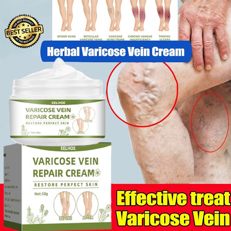 EELHOE Varicose Veins Cream 5G Obat Varises Salep Krim Permanen Varises Cream Varises Paling Ampuh O
