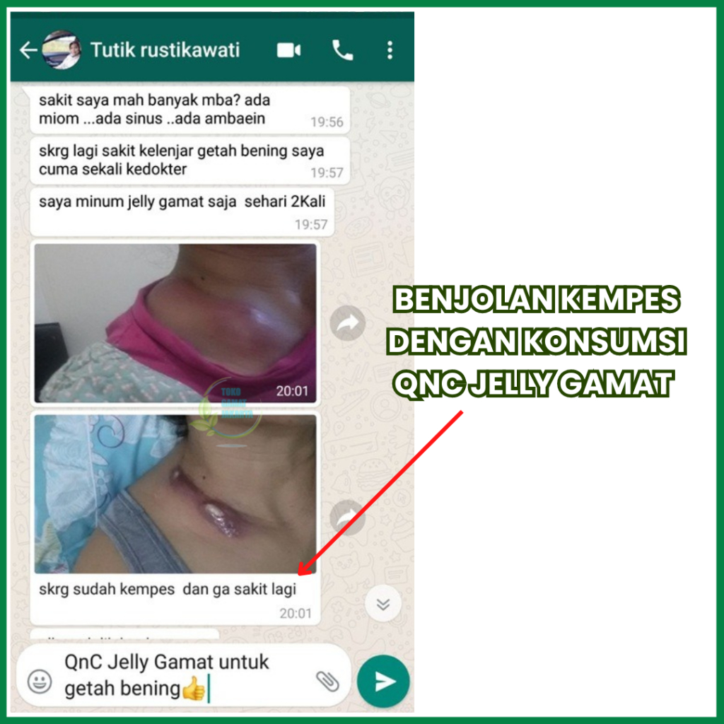 Obat Penghancur Benjolan Di Leher Kanan - Gondok - Tumor Jinak - Colli Herbal 100% Alami