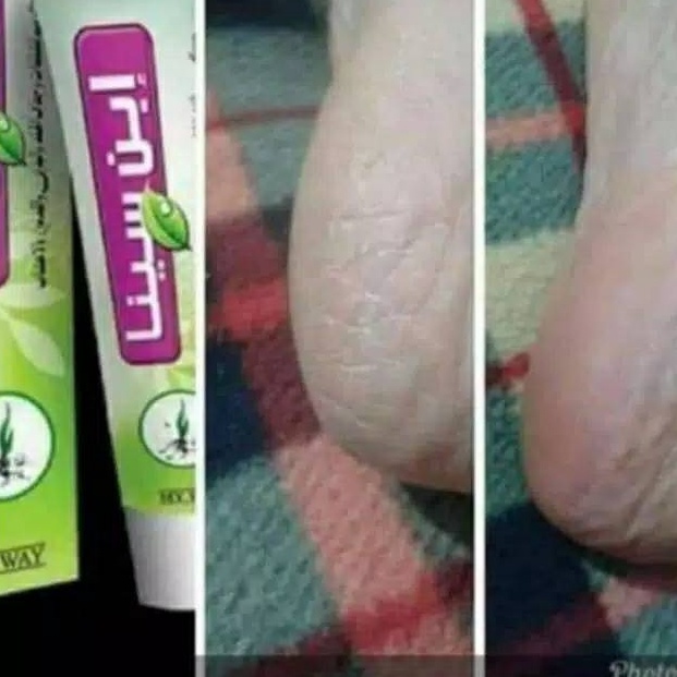KODE Y68W Ibnu Sina my way Cracked feet Cream