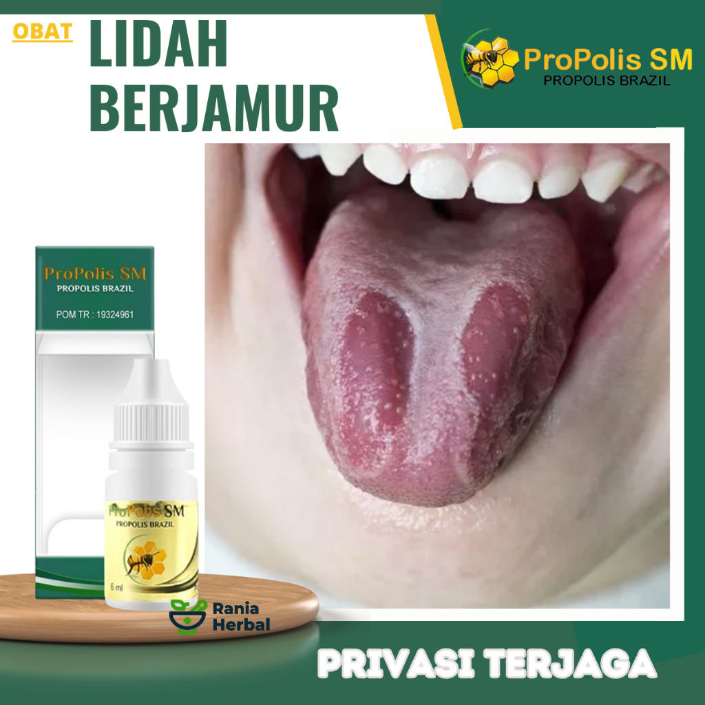 Obat Lidah Berjamur, Obat Lidah Mati Rasa, Obat Lidah Putih, Obat Lidah Pecah Pecah, Obat Penghilang