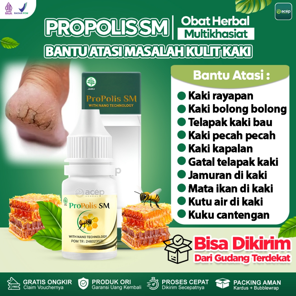 Obat Kaki Rayapan Telapak Kaki Bolong-Bolong dan Bau Kutu Air Rorombeheun Kaki Pecah-Pecah Cantengan