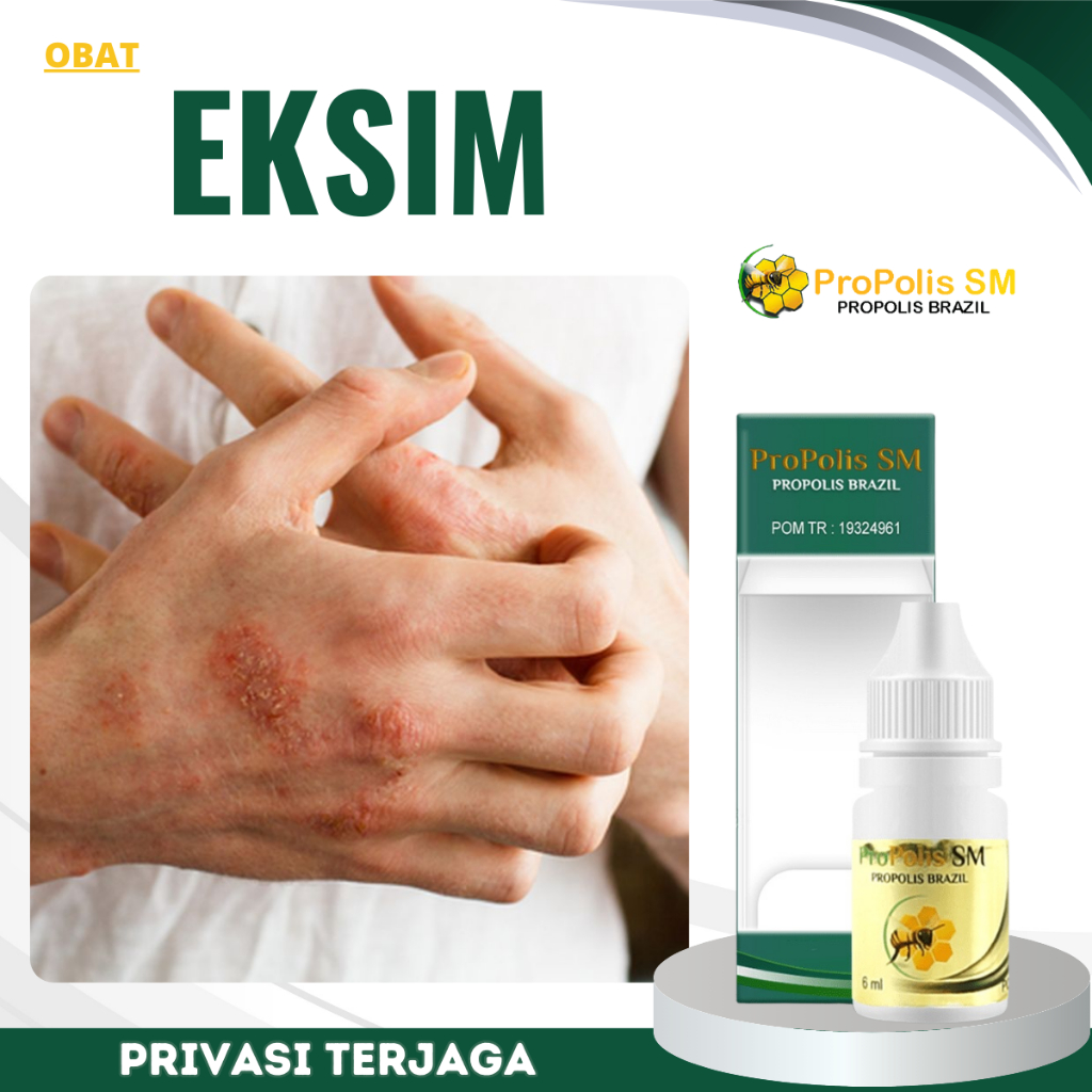 Obat Eksim, Obat Eksim Kering, Obat Eksim Basah, Obat Penghilang Eksim, Obat Oles Eksim, Obat Pereda