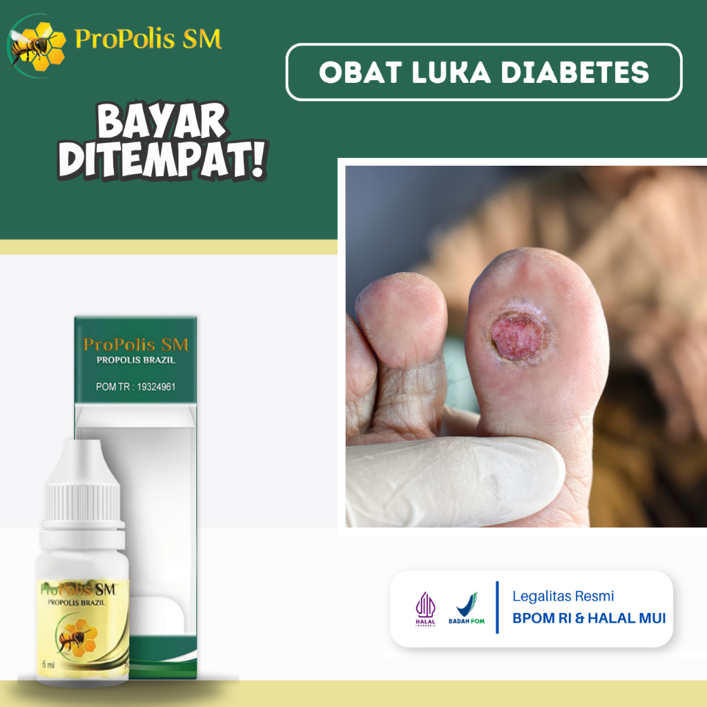 Obat Luka Diabetes Di Kaki, Obat Diabetes Basah, Obat Pengering Luka Diabetes, Obat Untuk Diabetes, 