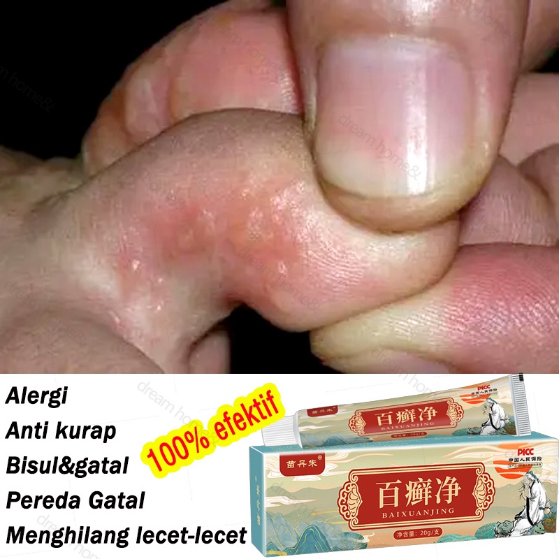 Obat gatal kulit paling ampuh Obat jerawat Obat scabies manusia 20G Obat benjolan/Obat kurap/Obat ek