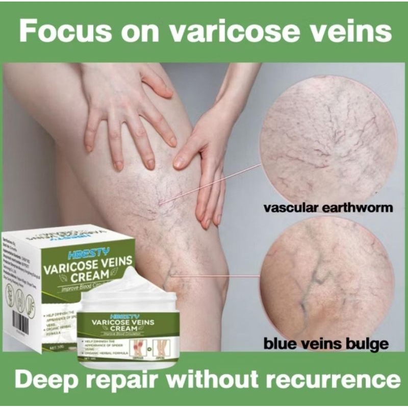 cream varicose nyeri varises obat varises