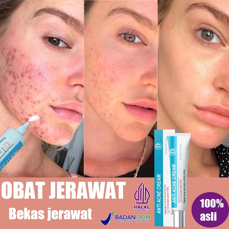 salep jerawat dan bekas jerawat menghilangkan bekas jerawat Bekas jerawat 20g menghilangkan jerawat 