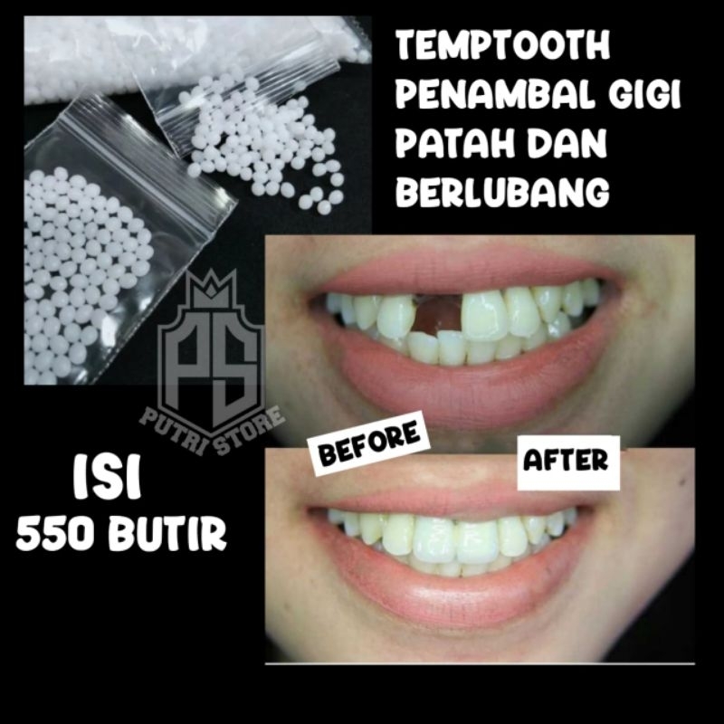 Termurah Tambal Gigi Temptooth solusi Penambal / Gigi Patah Terjamin