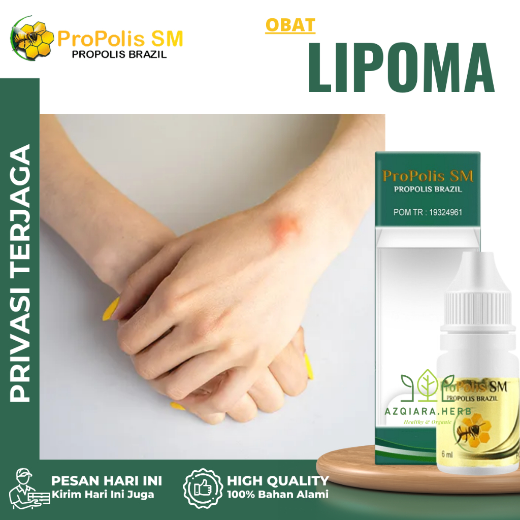 Obat Lipoma, Obat Penghilang Benjolan, Obat Penghancur Benjolan, Obat Oles Pengempis Benjolan - prop