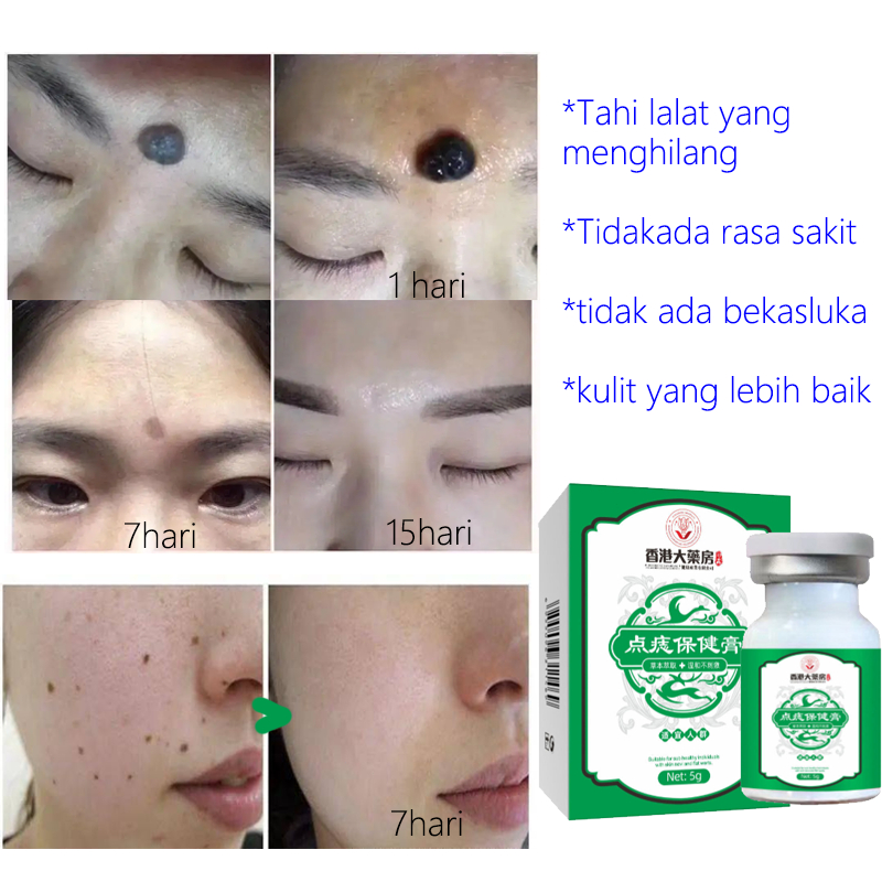 Penghilang Tahi Lalat Penghilang Kutil Skin Tag Remover Flek Dan Bintik Menghilangkan Pigmen Hitam K