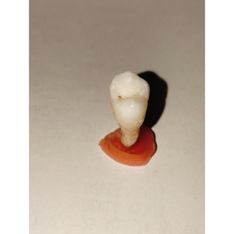 Gigi asli premolar 15