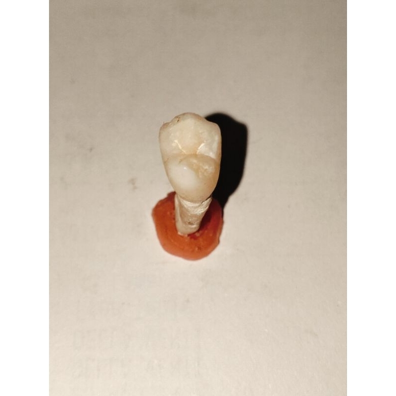 Gigi asli premolar 15