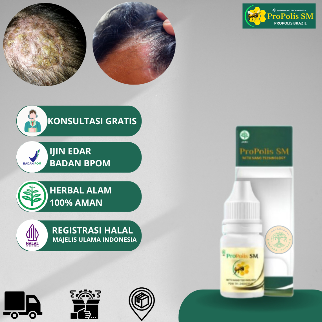 Obat Koreng Di Kepala  Kulit Bersisik Kering Luka Borok  Koreng Di Kepala  Obat Koreng di Kulit Kepa
