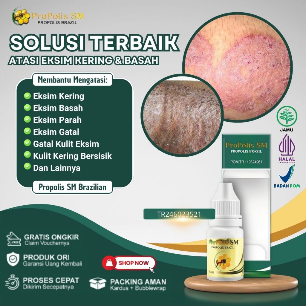 Obat Eksim, Obat Gatal Eksim, Obat Gatal Exim Kering Menahun, Obat Untuk Gatal2 Kering, Obat Gatal M