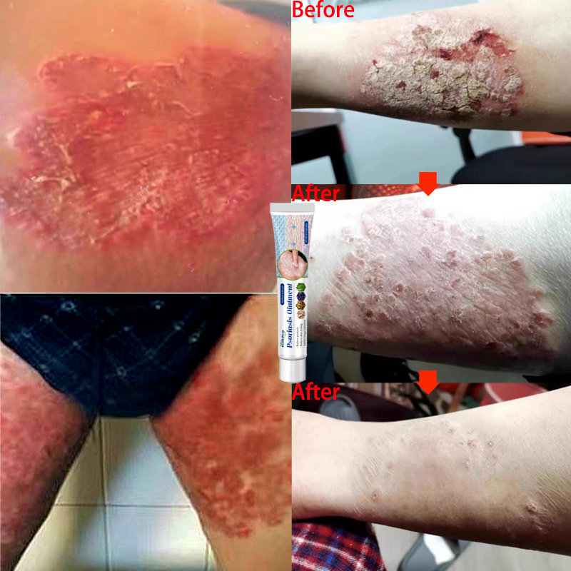 salep gatal obat gatal selangkangan obat jamur salep eksim saleb gatal paling ampuh salep selangkang