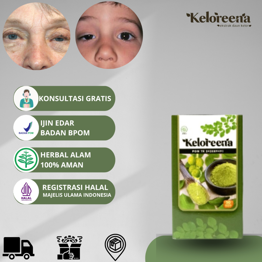Obat Mata Ptosis mata sipit sebelah Gangguan Pada Kelopak Mata Kelopak Mata Atas Turun Mata Bengkak 