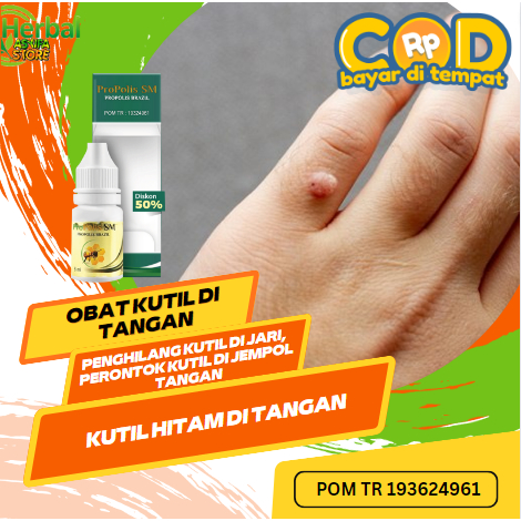Obat Kutil di Tangan, Penghilang Kutil di Jari, Perontok Kutil di Jempol Tangan / Kutil Hitam di Tan