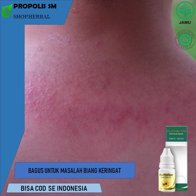 obat biang keringat Propolis SM Obat Oles OBAT BIANG KERINGAT, OBAT HERBAL UNTUK BIANG KERINGAT, OBA