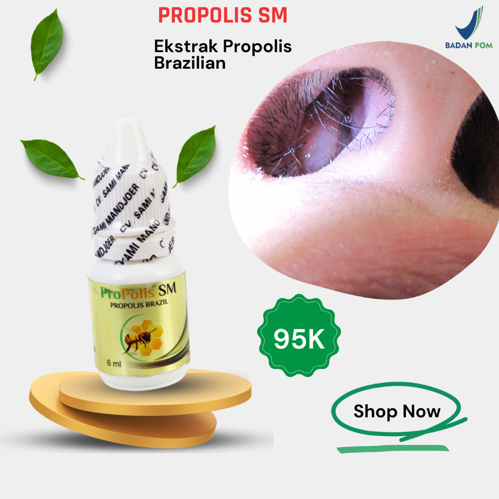 Obat Sinusitis Polip Hidung Obat Rhinitis Polip Sinusitis Kronis Akut Herbal Sinusitis - Propolis Sm