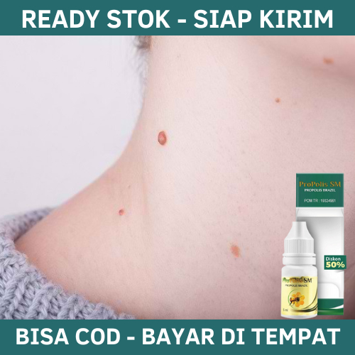 Obat Kutil Di Leher, Obat Penghilang Kutil Di Leher, Obat Perontok Kutil Di Leher, Obat Papiloma, Sk