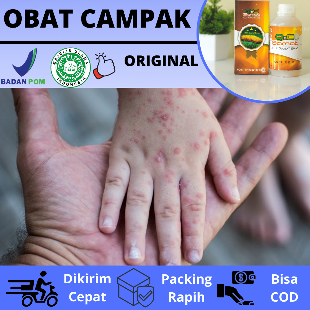 Obat Campak Anak Dan Dewasa, Salep Buat Gatal Bercak Campak, Tampek, Campak Rubella, Gabagean, Bekas