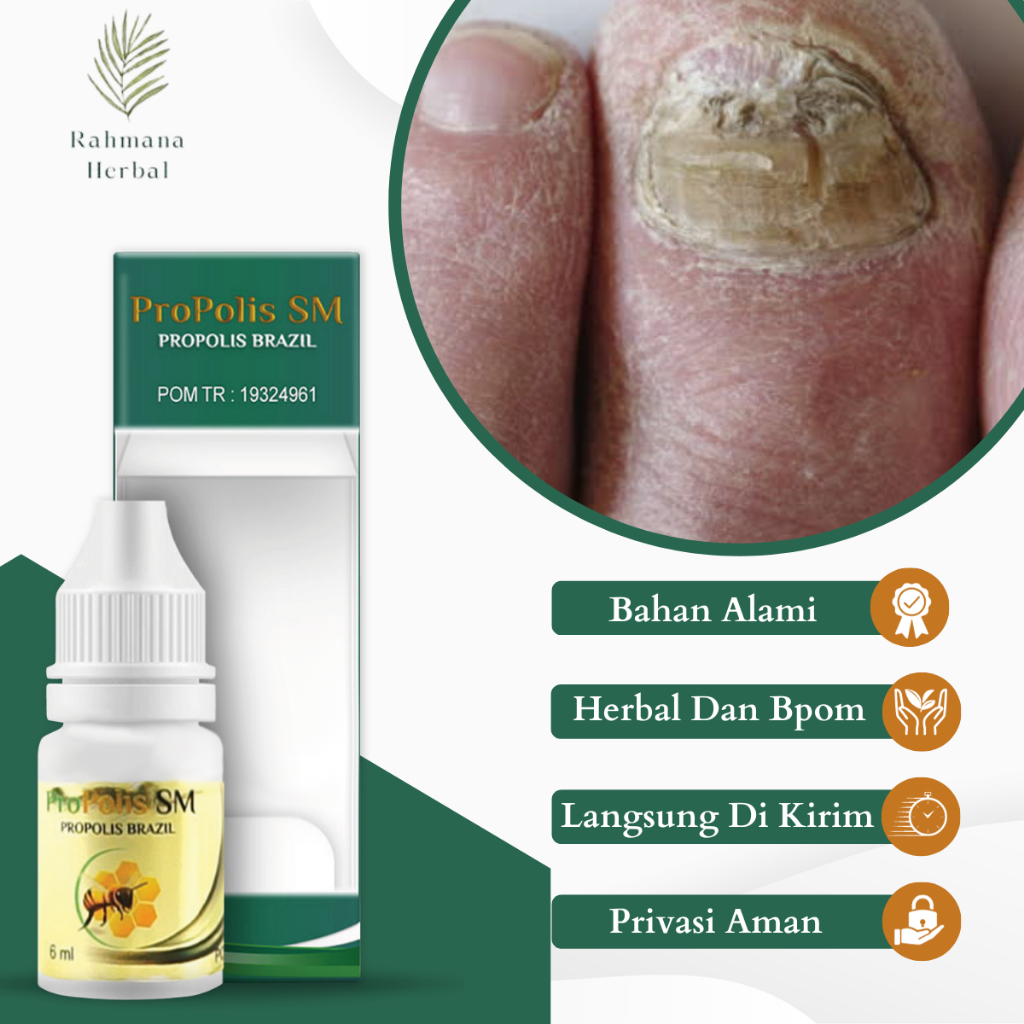 Obat Jamur Kuku, Obat Kuku Rusak, Obat Kuku Berjamur, Obat Pembersih Kuku Rusak, Obat Cantengan, Oba