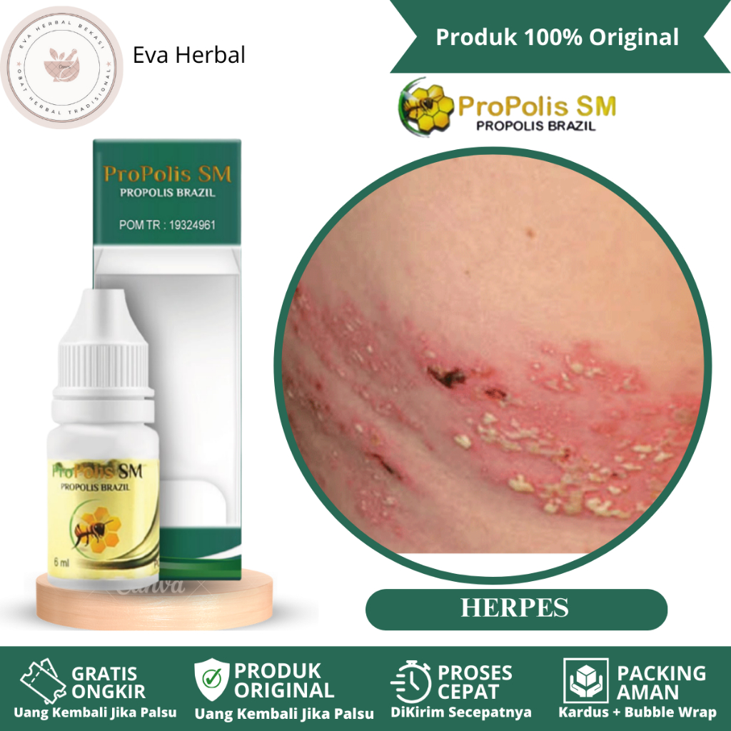 Obat Herpes, Obat Herpes Kulit, Obat Herpes Zoster, Obat Herpes Genital Pria/Wanita, Obat Herpes Sim