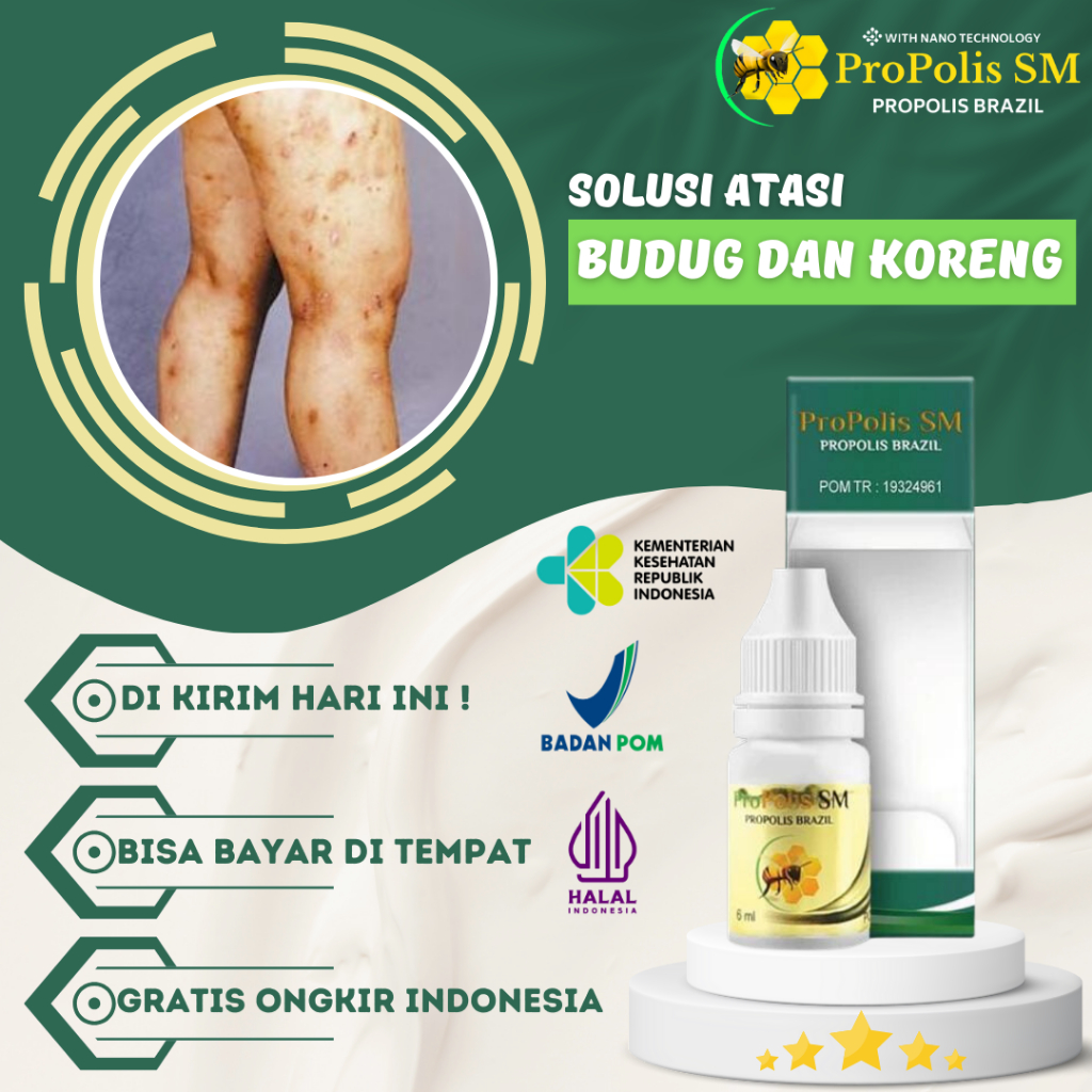 Obat Budug - Obat Borok - Obat Koreng - Obat Kulit Gatal - Obat Budug Di Kaki - Obat Budug Santri - 