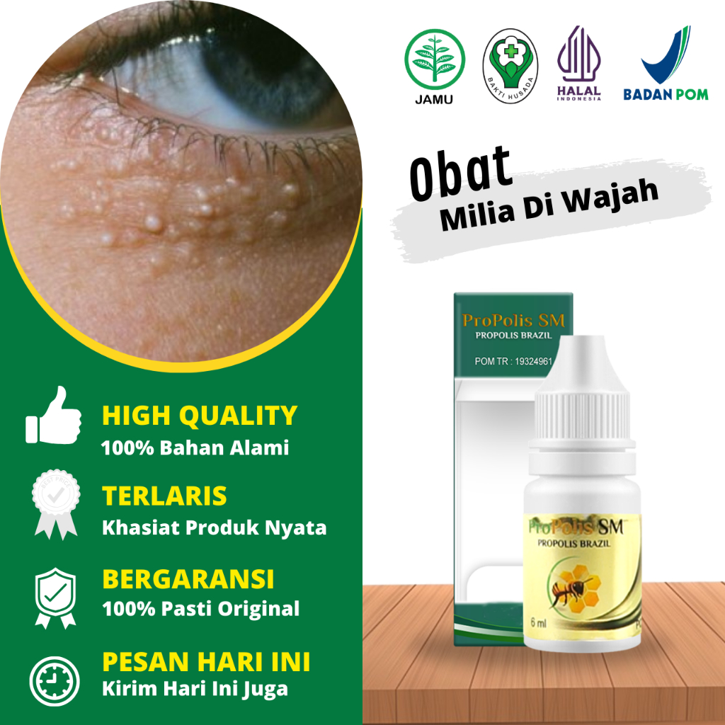 Obat Milia Herbal, Obat Milia Di Bawah Mata, Obat Milia Pada Wajah, Obat Milia Di Kelopak Mata, Obat