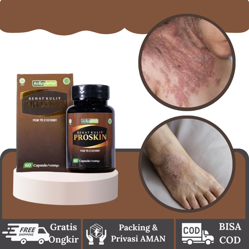 Obat Gatal Eksim Kering Basah Menahun, Obat Gatal Eksim Kering Menahun, Obat Eksim Exim Kering Basah