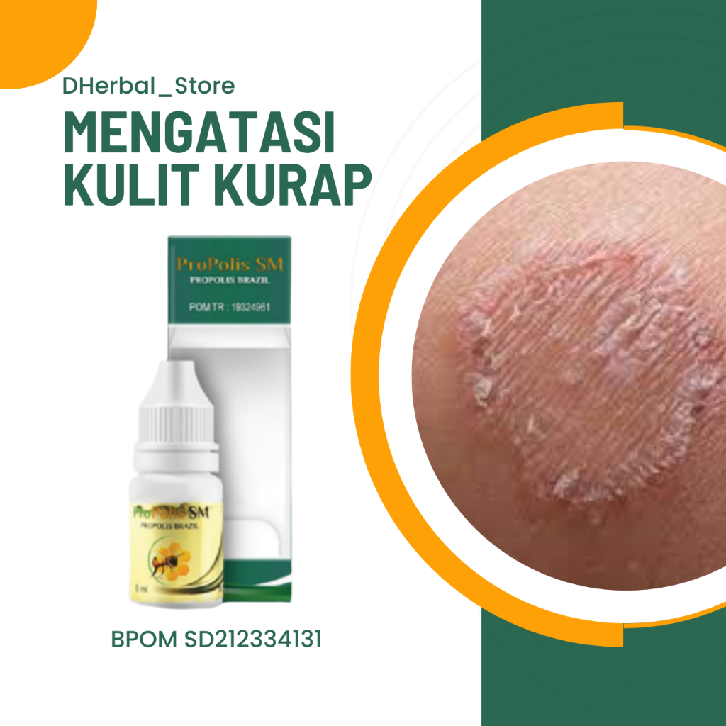 Propolis SM, Obat Kulit Kurap, Obat Kurap Kering, Obat Kurap di Kepala, Obat Kurapdi Selangkangan, O