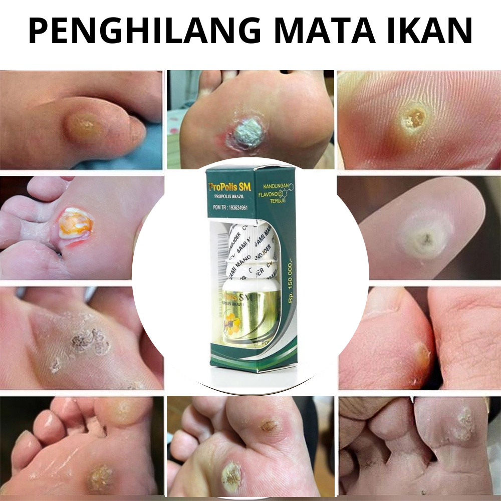 OBAT PENYAKIT MATA IKAN, CLAVUS BUKAN PLESTER SALEP CALLUSOL, OBAT SALEP MATA IKAN DI TELAPAK KAKI Y
