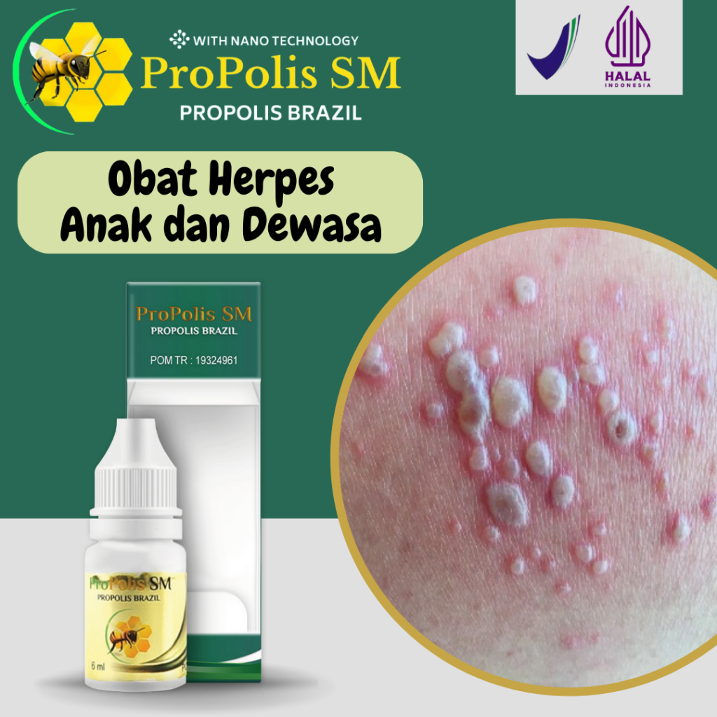 Obat Herpes Kulit, Obat Herpes Zoster, Herpes Genital, Herpes Kelamin, Herpes Simplex, Herpes Di Bib