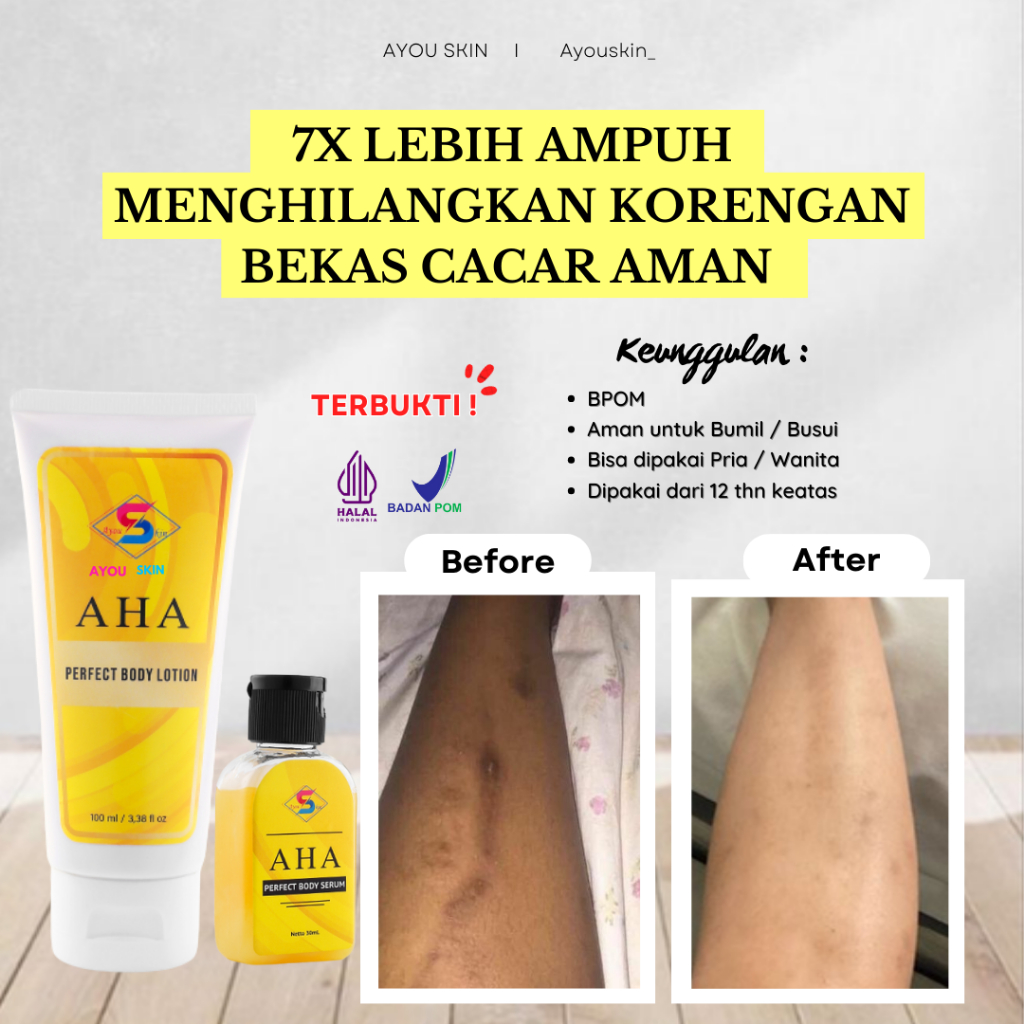 Menghilangkan Penghilang Bekas Korengan Ampuh Kudis Bekas Luka Cacar Ampuh Menghilangkan Korengan Am