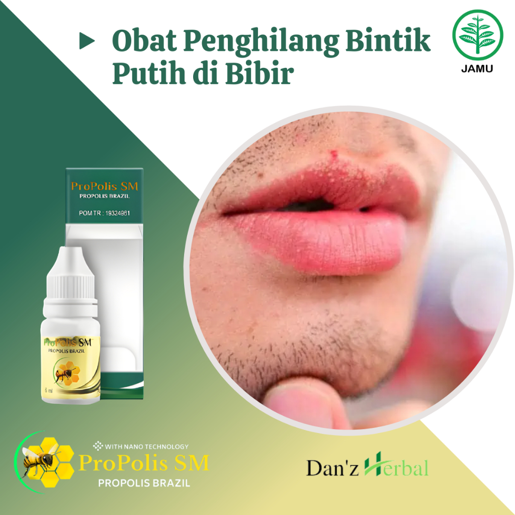 Obat Penghilang Bintik Putih di Bibir Fordyce Spots Bruntusan di Bibir Herpes Simpleks Milia Bibir B