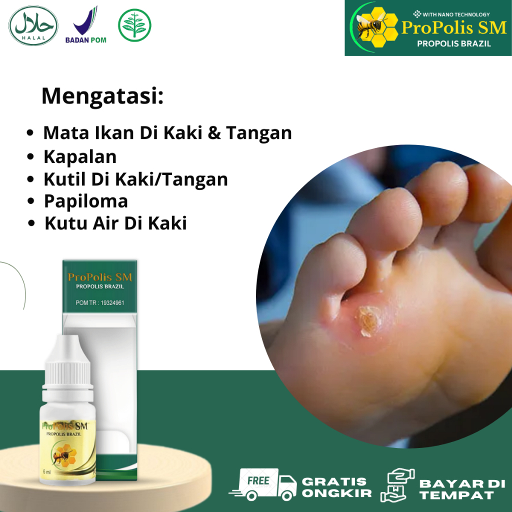 Obat Mata Ikan, Obat Penghilang Kutil Mata Ikan, Salep Mata Ikan, Obat Mata Ikan Di Kaki, Obat Mata 