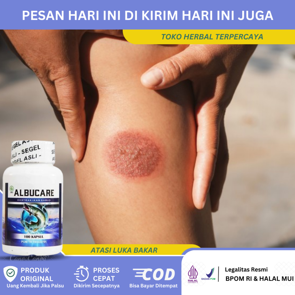 Obat Luka Bakar, Obat Luka Terkena Kenalpot, Obat Pengering Luka Bakar, Obat Luka Bernanah, Obat Tet